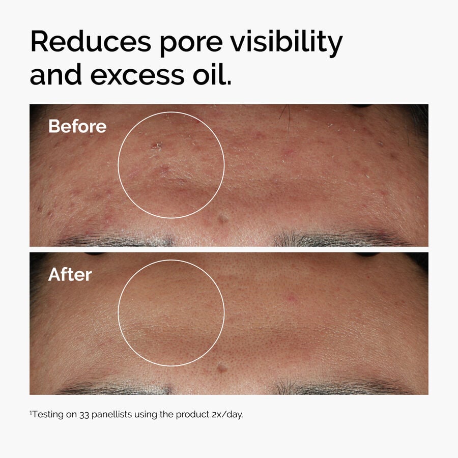 niacinamide-10-zinc-1-l4 ord-niacinamide-zinc-blemish-serum-before-after-pores.jpg