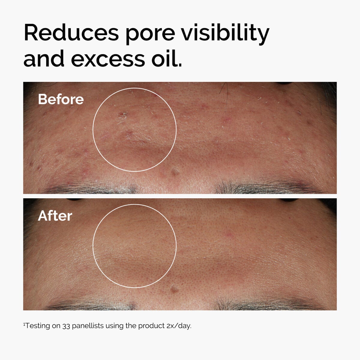 niacinamide-10-zinc-1-l4 ord-niacinamide-zinc-blemish-serum-before-after-pores.jpg