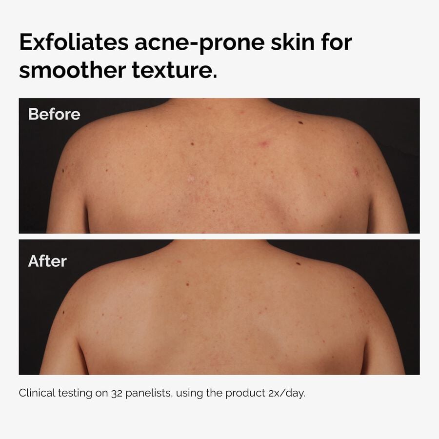 the-body-care-collection-p6 ord-salicylic-acid-body-serum-before-after-graphic-NA.jpg