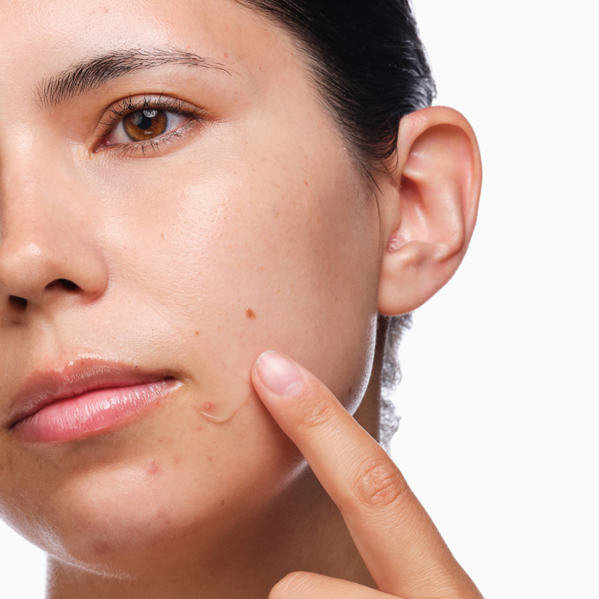 the-acne-set-v9 rdn-the-acne-set-application.png